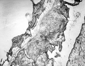 F,26y. | membranous glomerulopathy F,26y. | membranous glomerulopathy